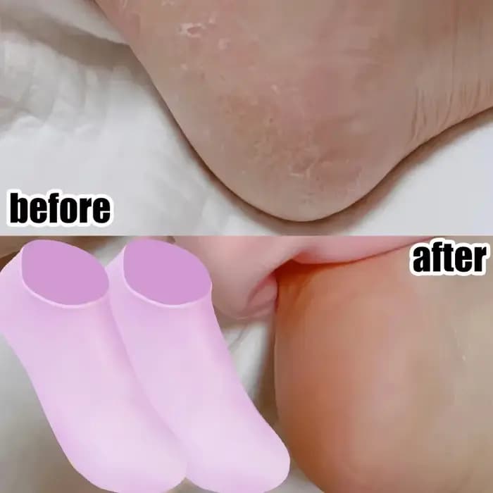 1 paire de chaussettes de soin des pieds en Silicone