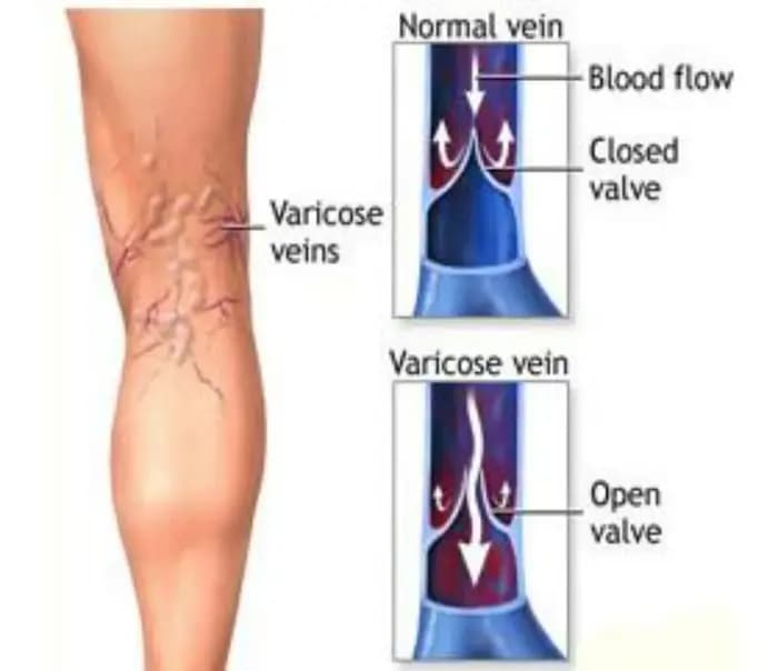 Chaussettes de Compression médicales